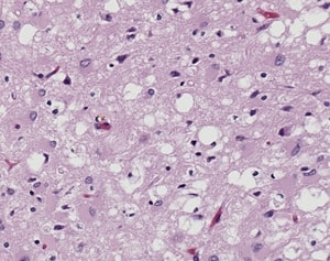 CDC / Teresa Hammett