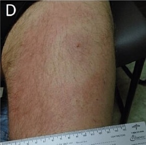 Schotthoefer et al. (fig. 2)