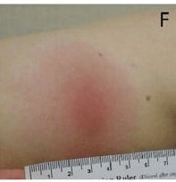 Schotthoefer et al. (fig. 3)