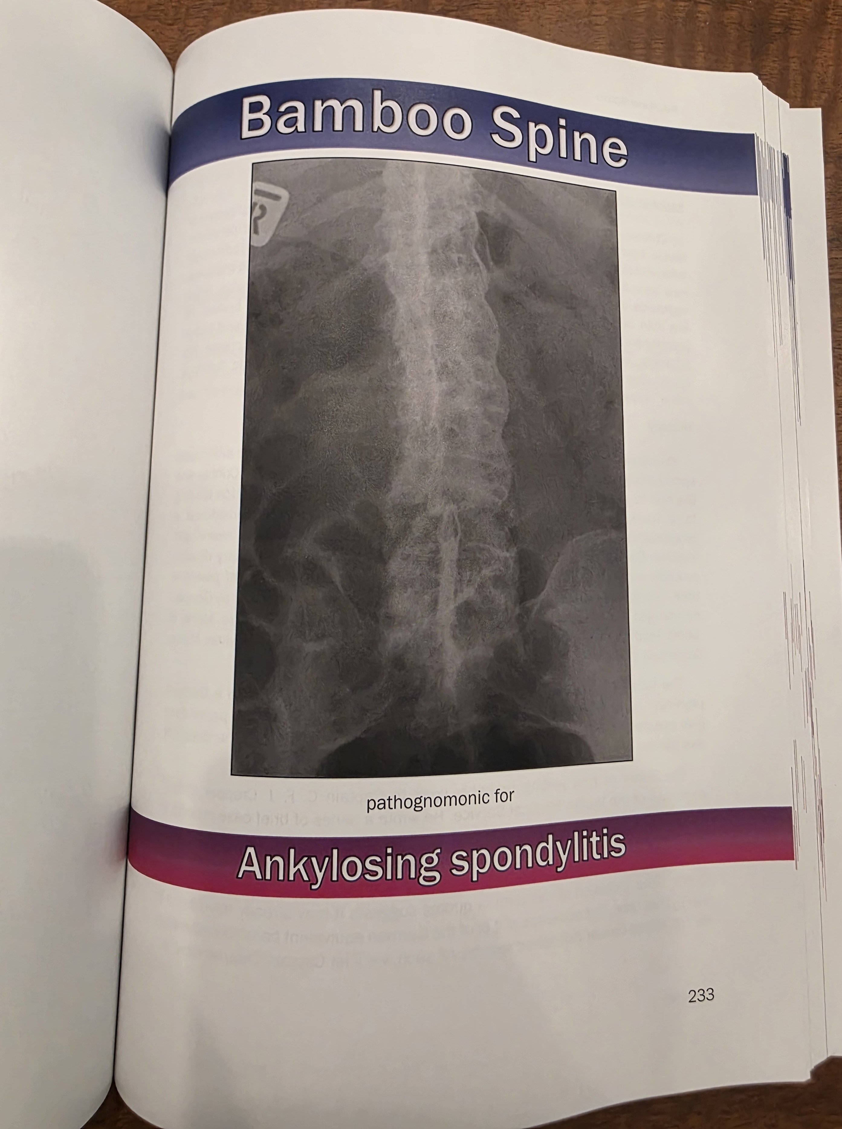 Sample entry: Bamboo Spine — pathognomonic for ankylosing spondylitis