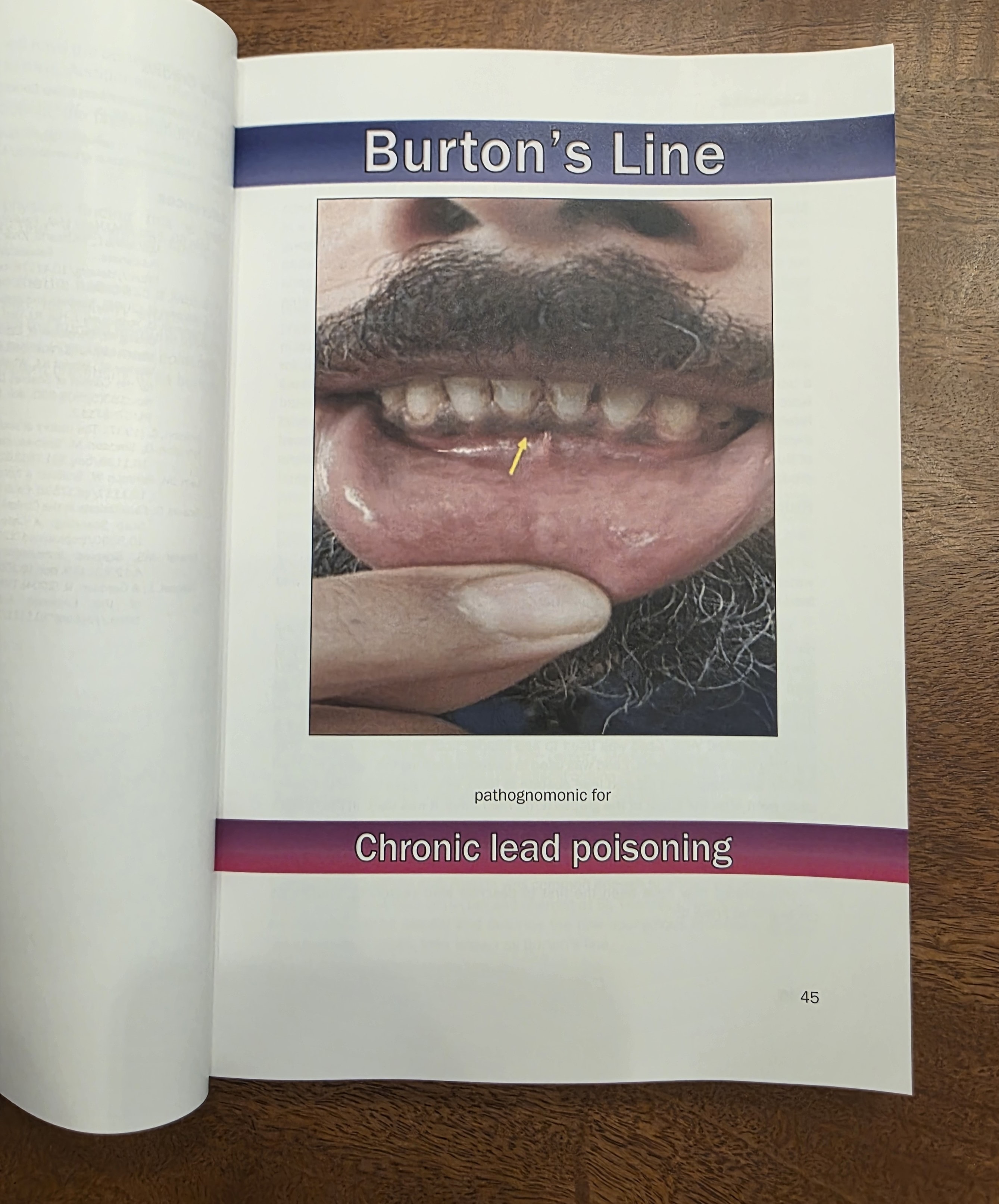 Sample entry: Burton's Line — pathognomonic for chronic lead poisoning